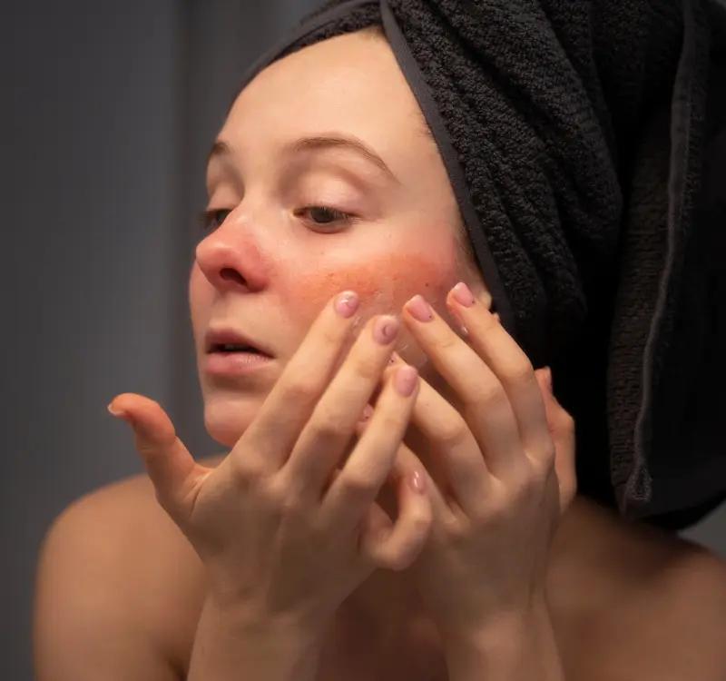 How to Reduce Redness on the Face? Causes and Remedies