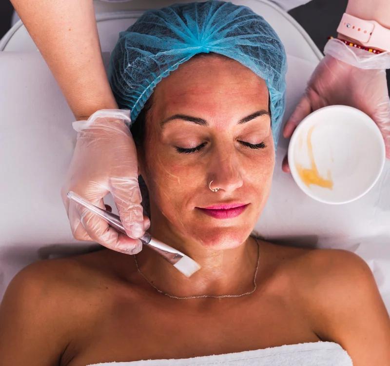 5 Top Benefits Of Using Chemical Peel For Dark Spots