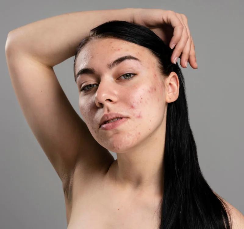 The Best Guide To Achieve Clearer Skin! Effective Home Remedies To Fight Acne & Pimples