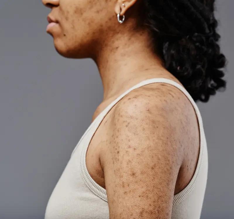 Clear Your Skin: Best Ways To Get Rid Of Dark Spots