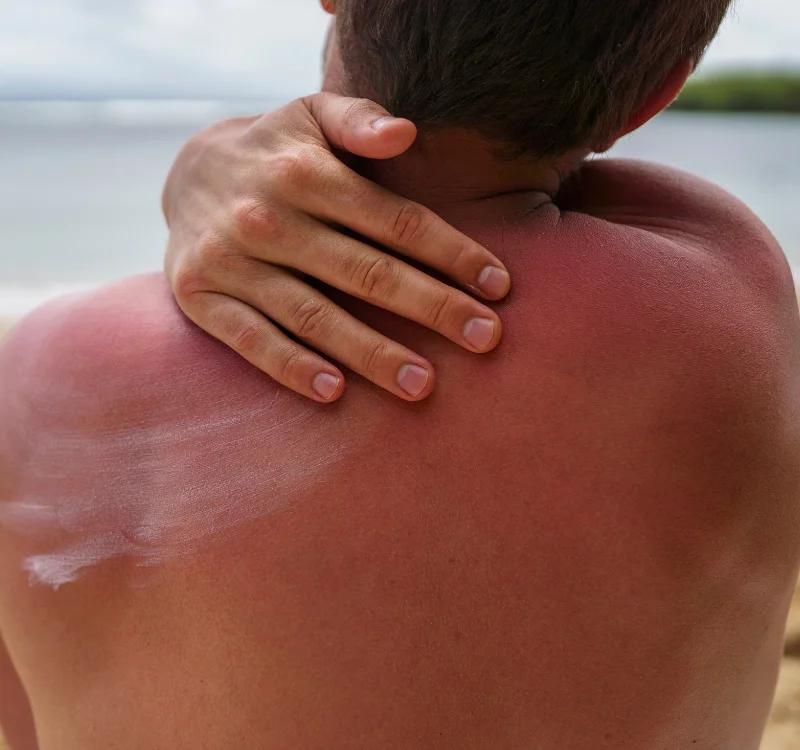 How To Repair Sun Damaged Skin? Top 6 Problems Caused By Sun Damage