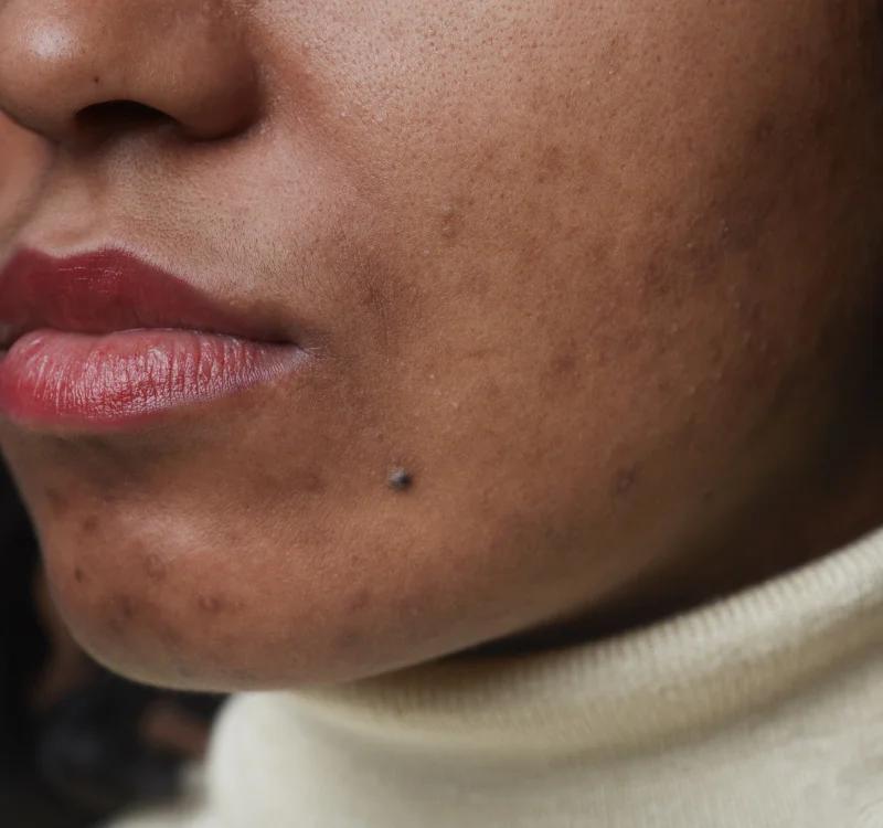 What Is Hyperpigmentation: 5 Main Types, Causes, Remedies & Best Creams and Serums to Reduce It