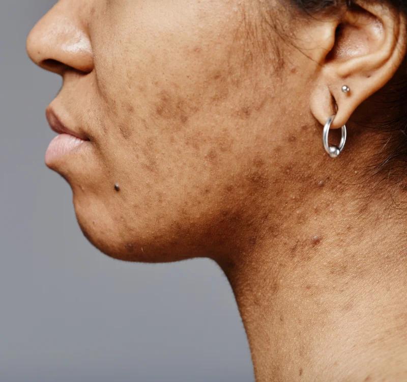 Frustrated At Your Hyperpigmentation Serum Not Showing Result? Do This…